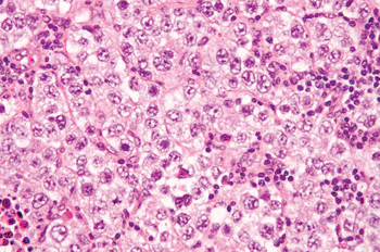 Image: Histological section of testicular cancer (Photo courtesy of Nephron).